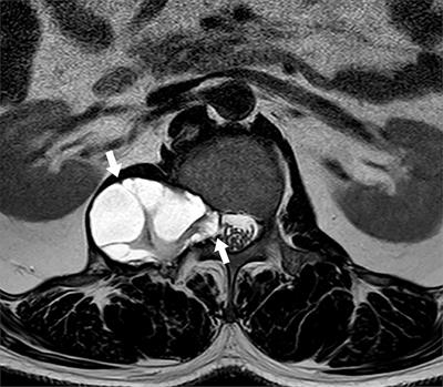 Case Report: Huge Dumbbell-Shaped Primary Hydatid Cyst Across the Intervertebral Foramen